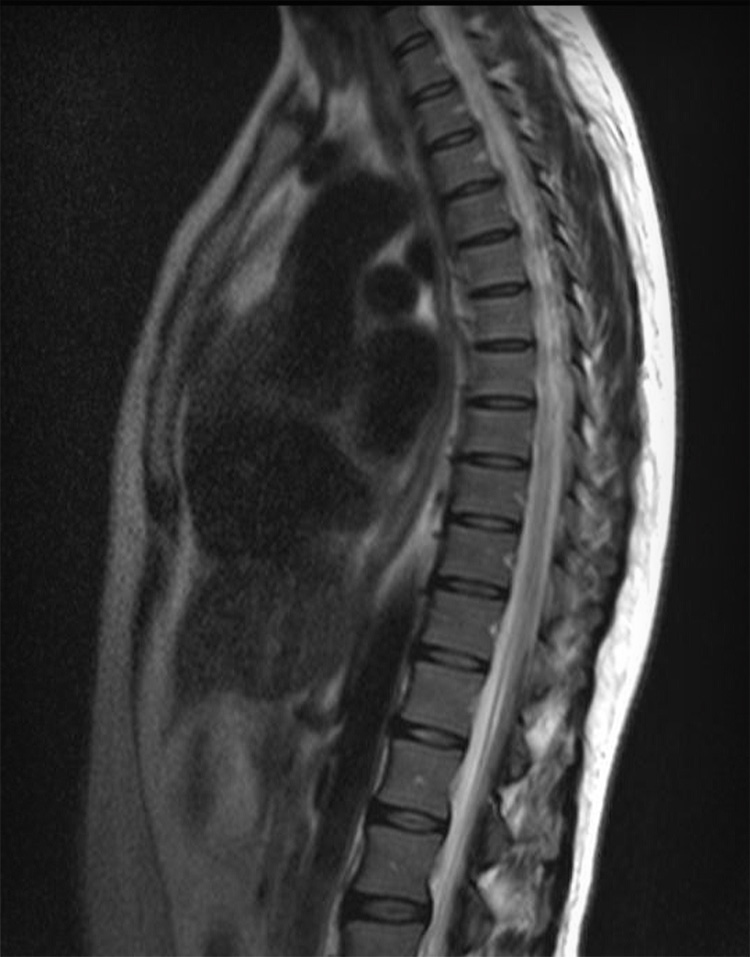 «МРТ спинного мозга пояснично-крестцового отдела позвоночника»